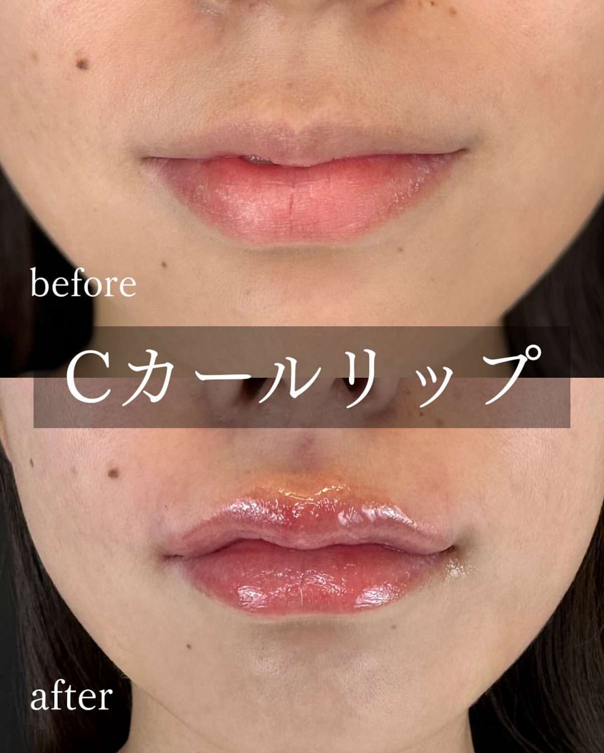 Cカールリップの症例写真