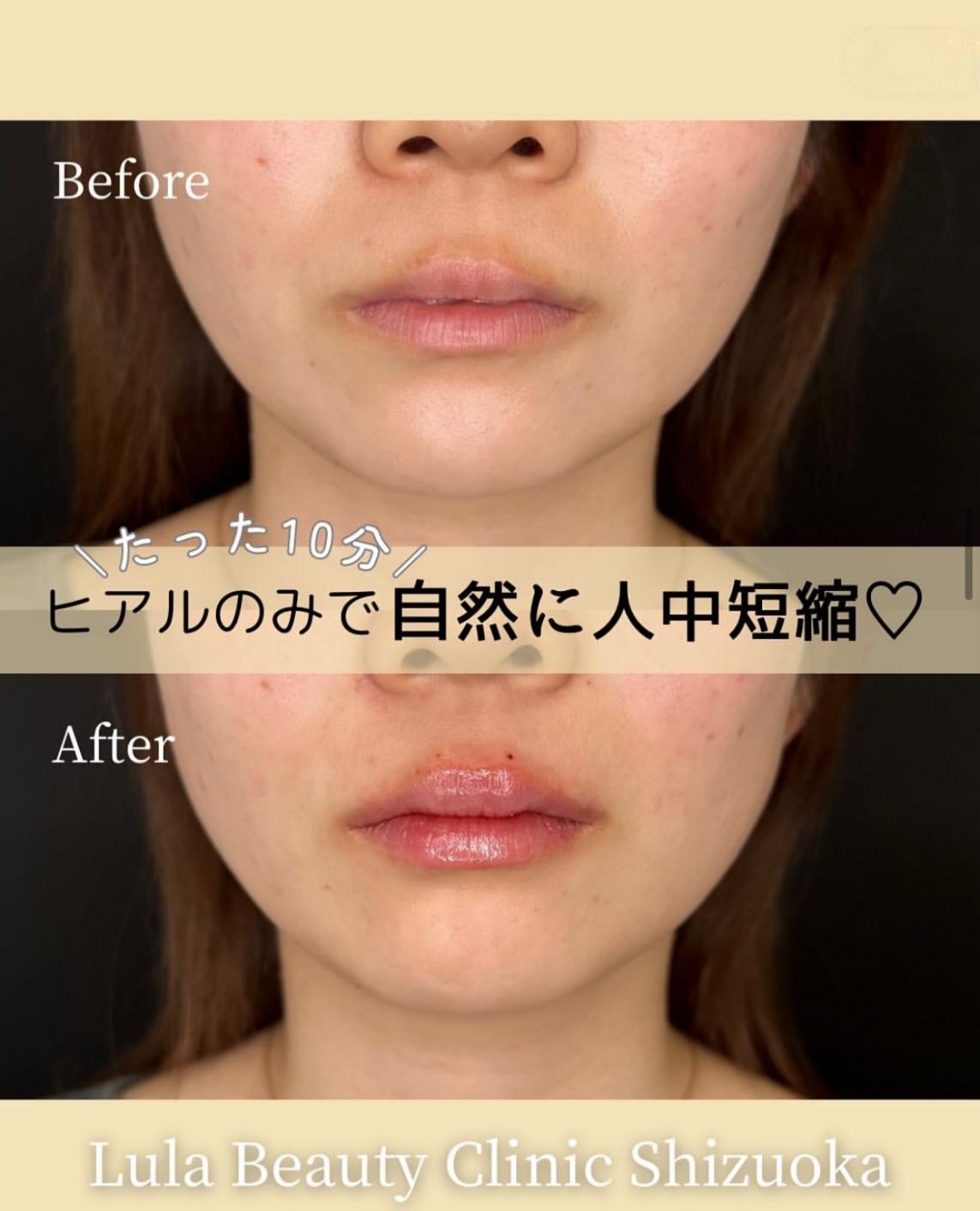 Cカールリップの症例写真