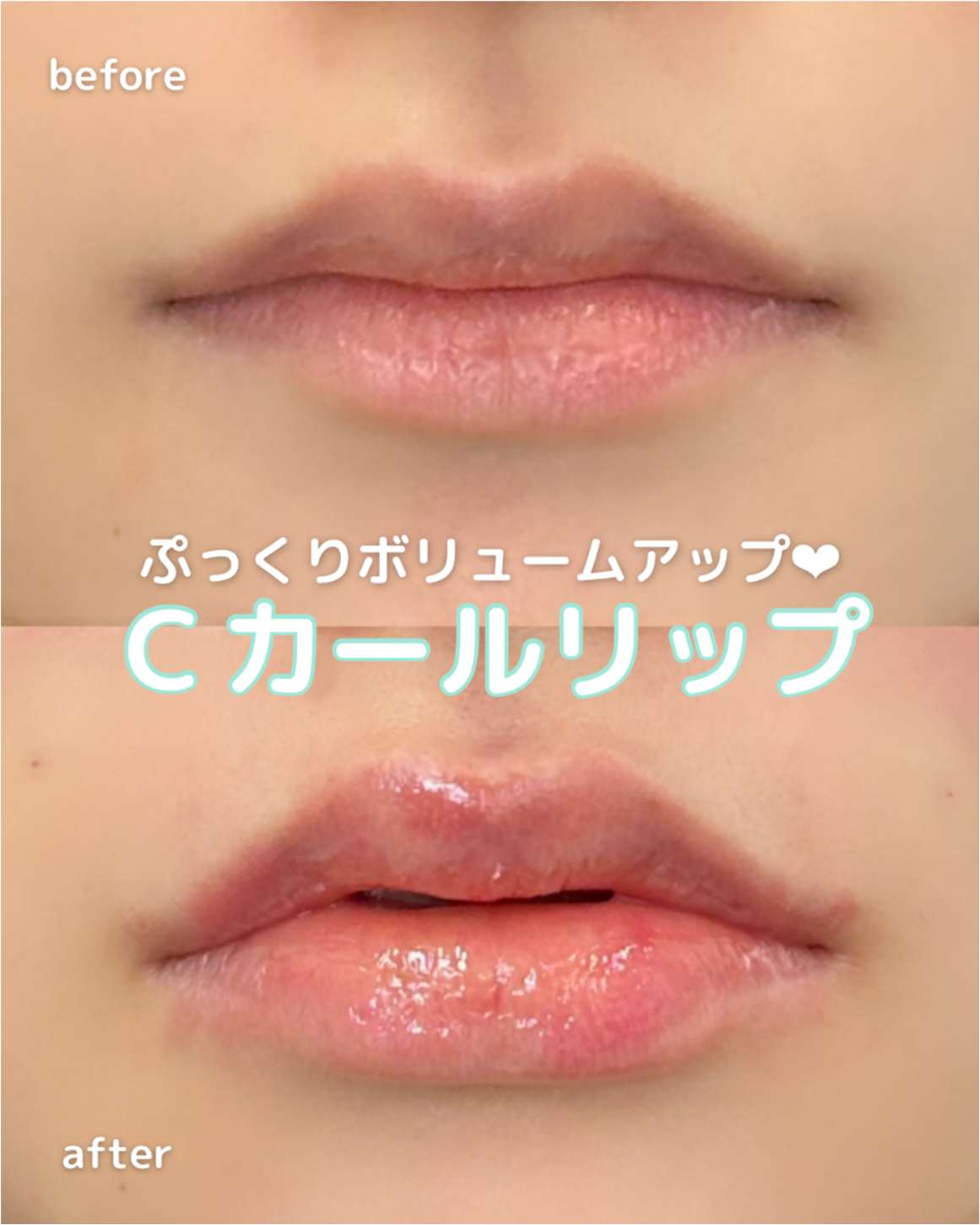 Cカールリップの症例写真