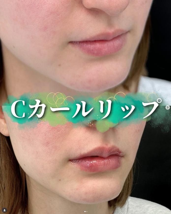 Cカールリップの症例写真