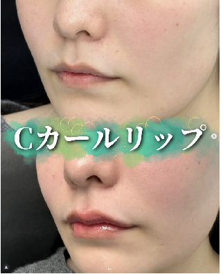 Cカールリップの症例写真