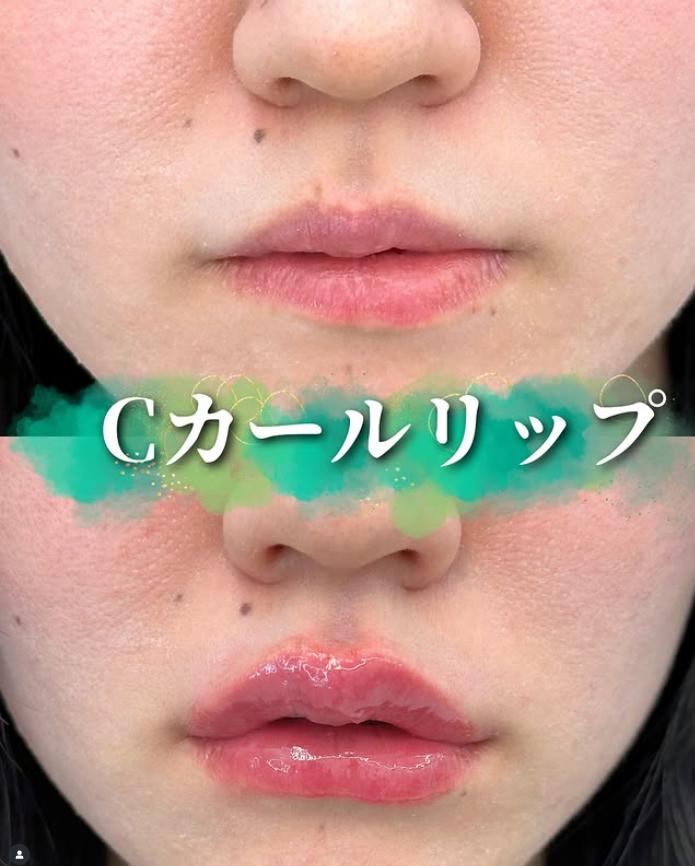 Cカールリップの症例写真