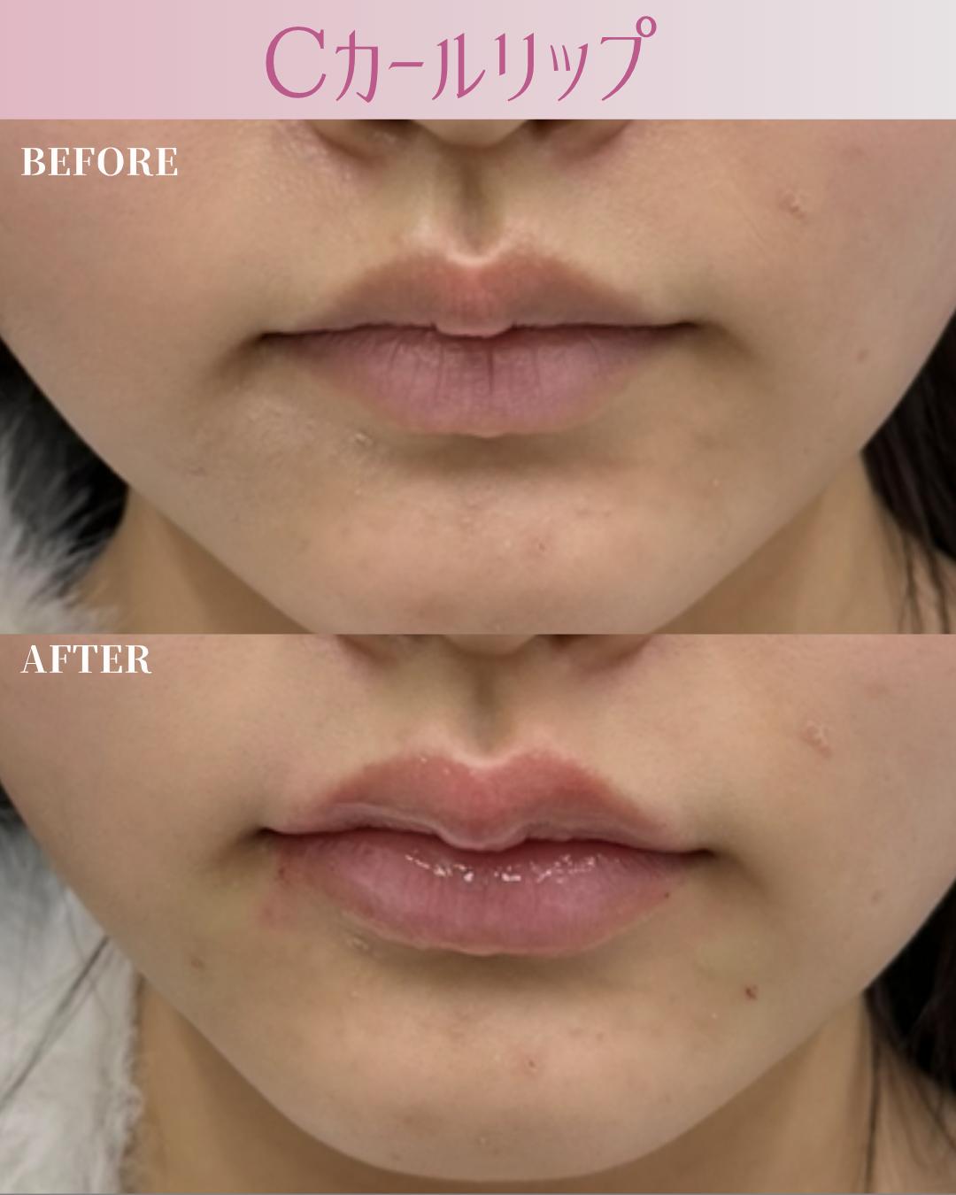 Cカールリップの症例写真