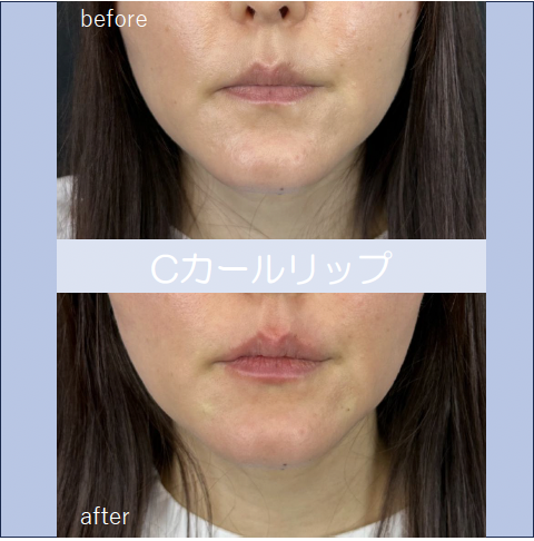 Cカールリップの症例写真