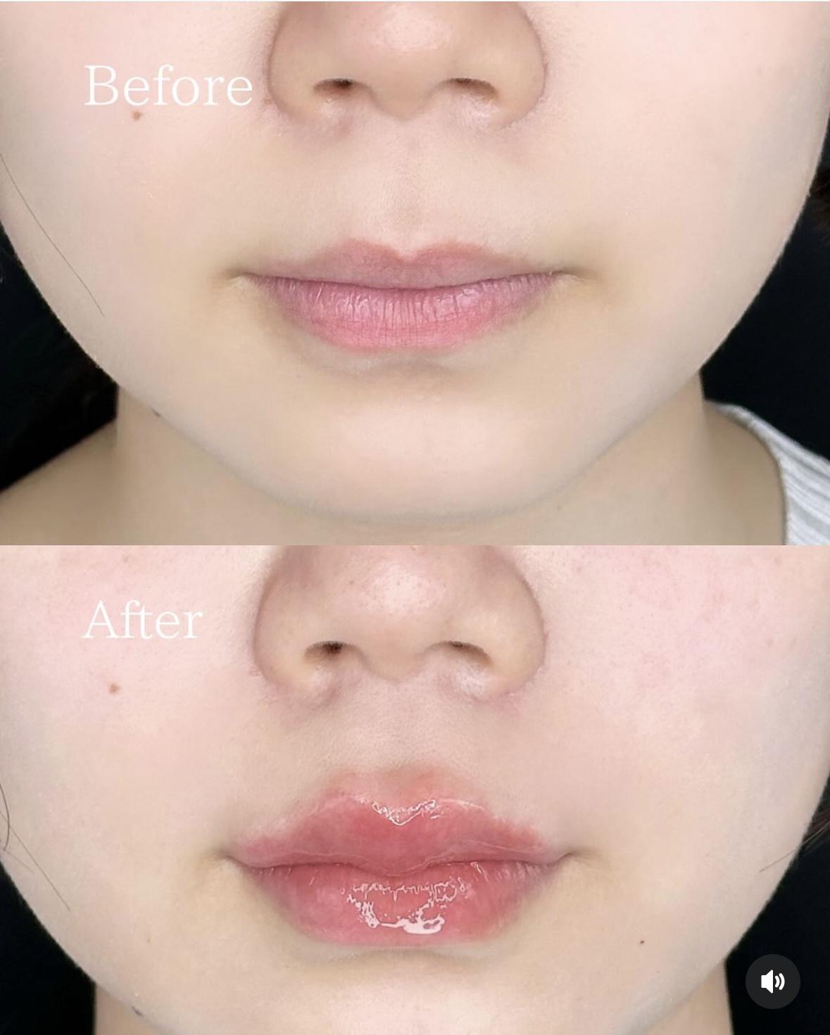 Cカールリップの症例写真