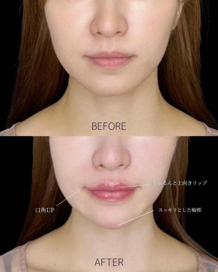 Cカールリップの症例写真