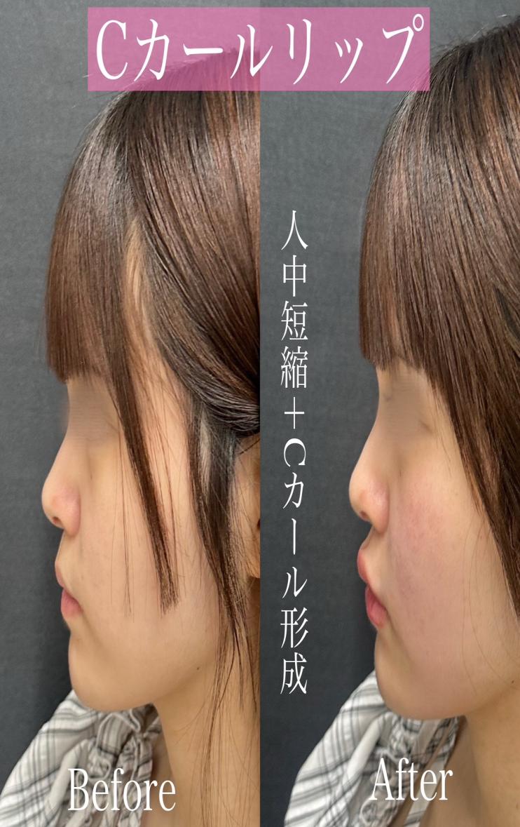 Cカールリップの症例写真