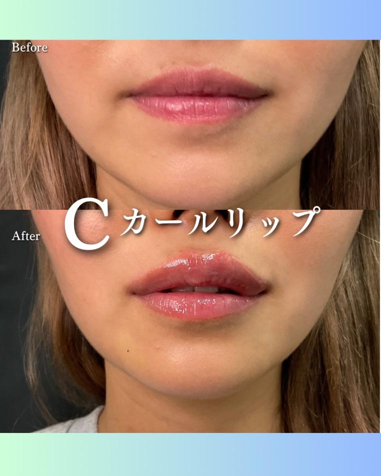 Cカールリップの症例写真