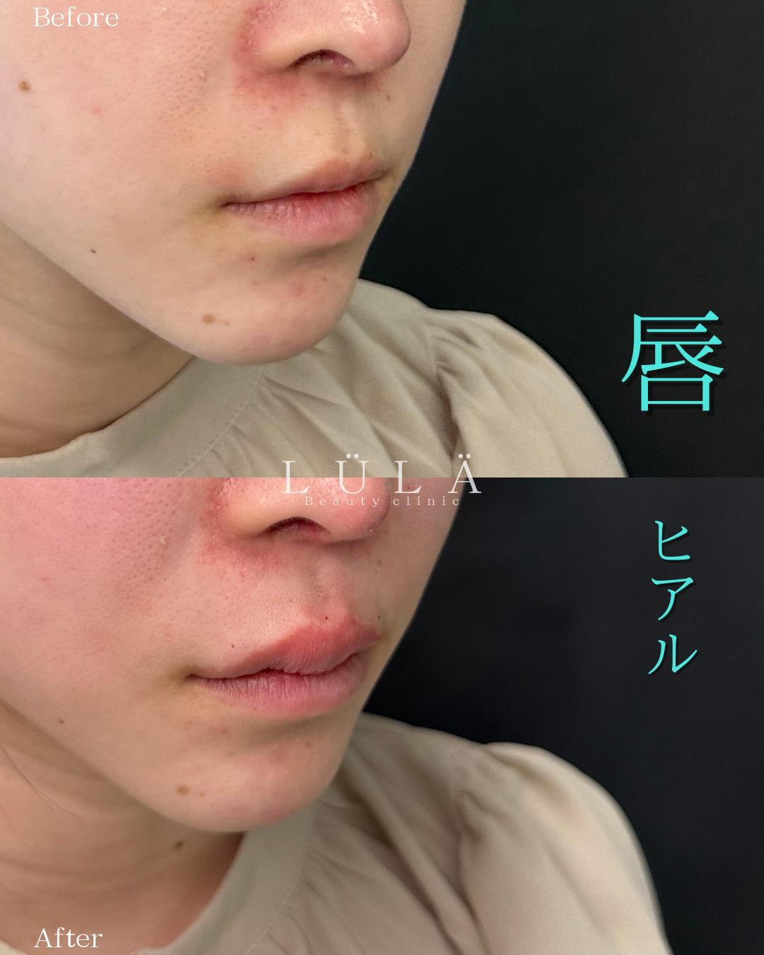 Cカールリップの症例写真