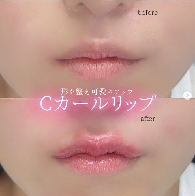 Cカールリップの症例写真