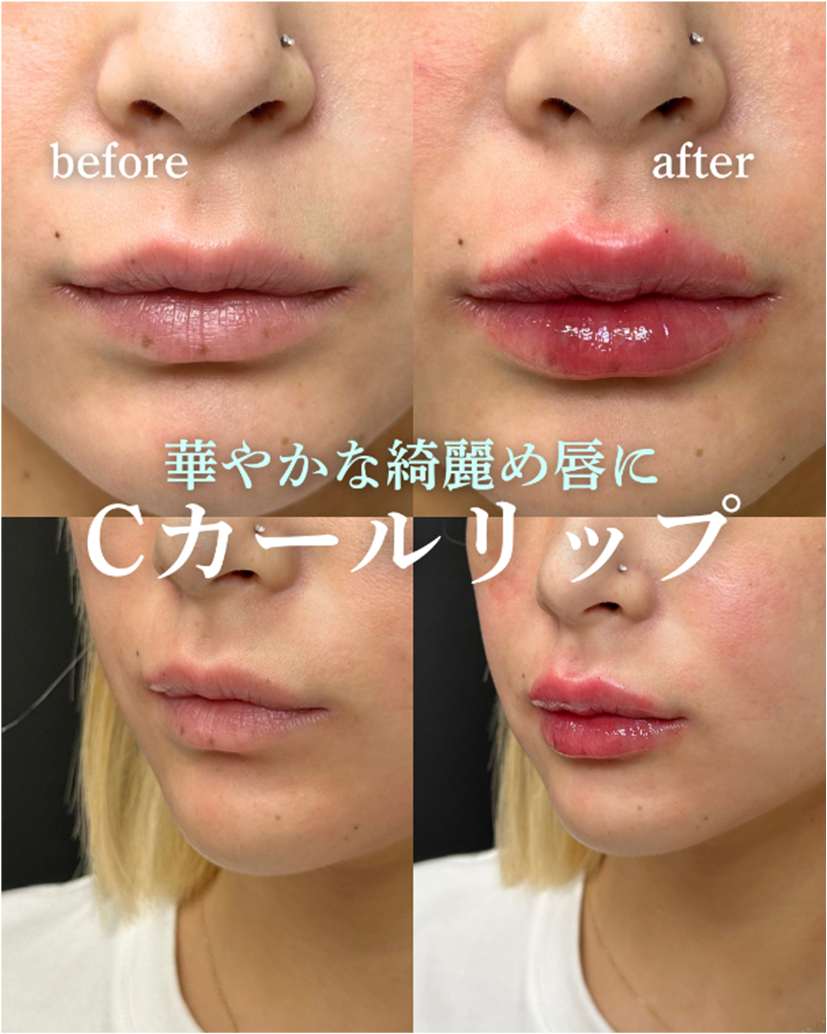 Cカールリップの症例写真