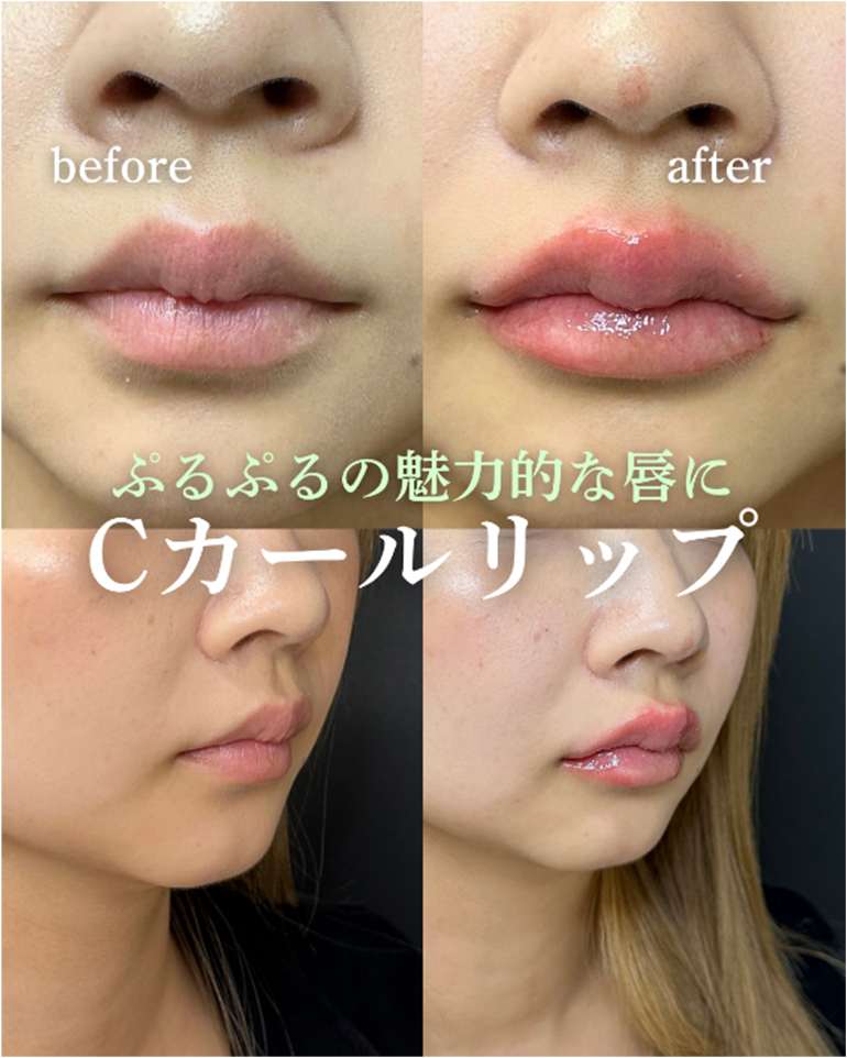 Cカールリップの症例写真