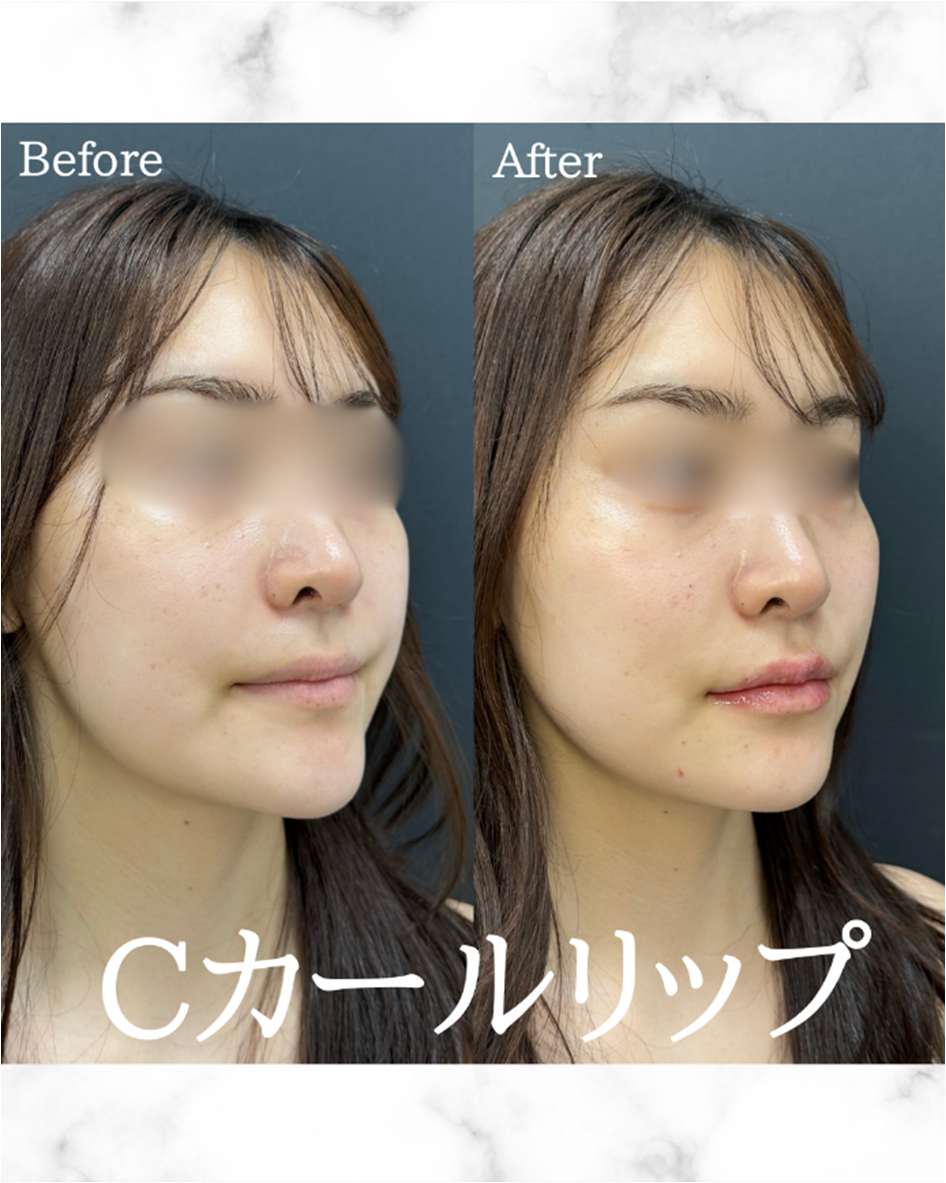 Cカールリップの症例写真