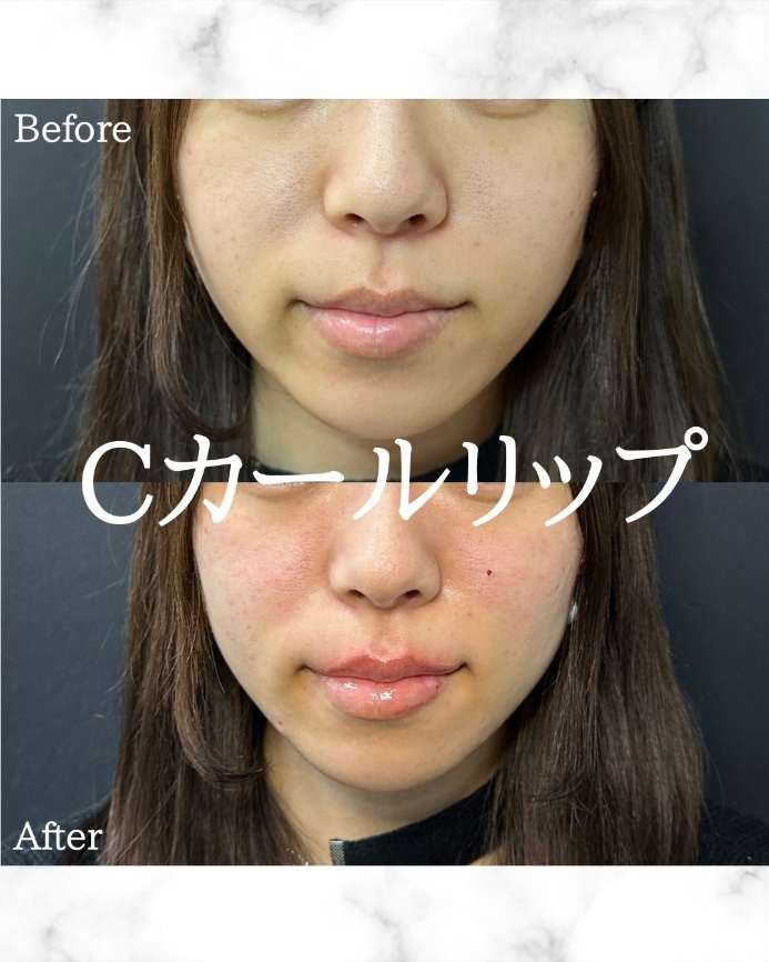 Cカールリップの症例写真
