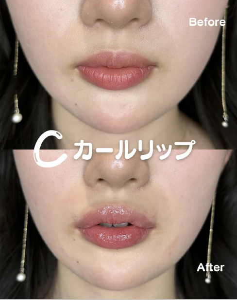 Cカールリップの症例写真