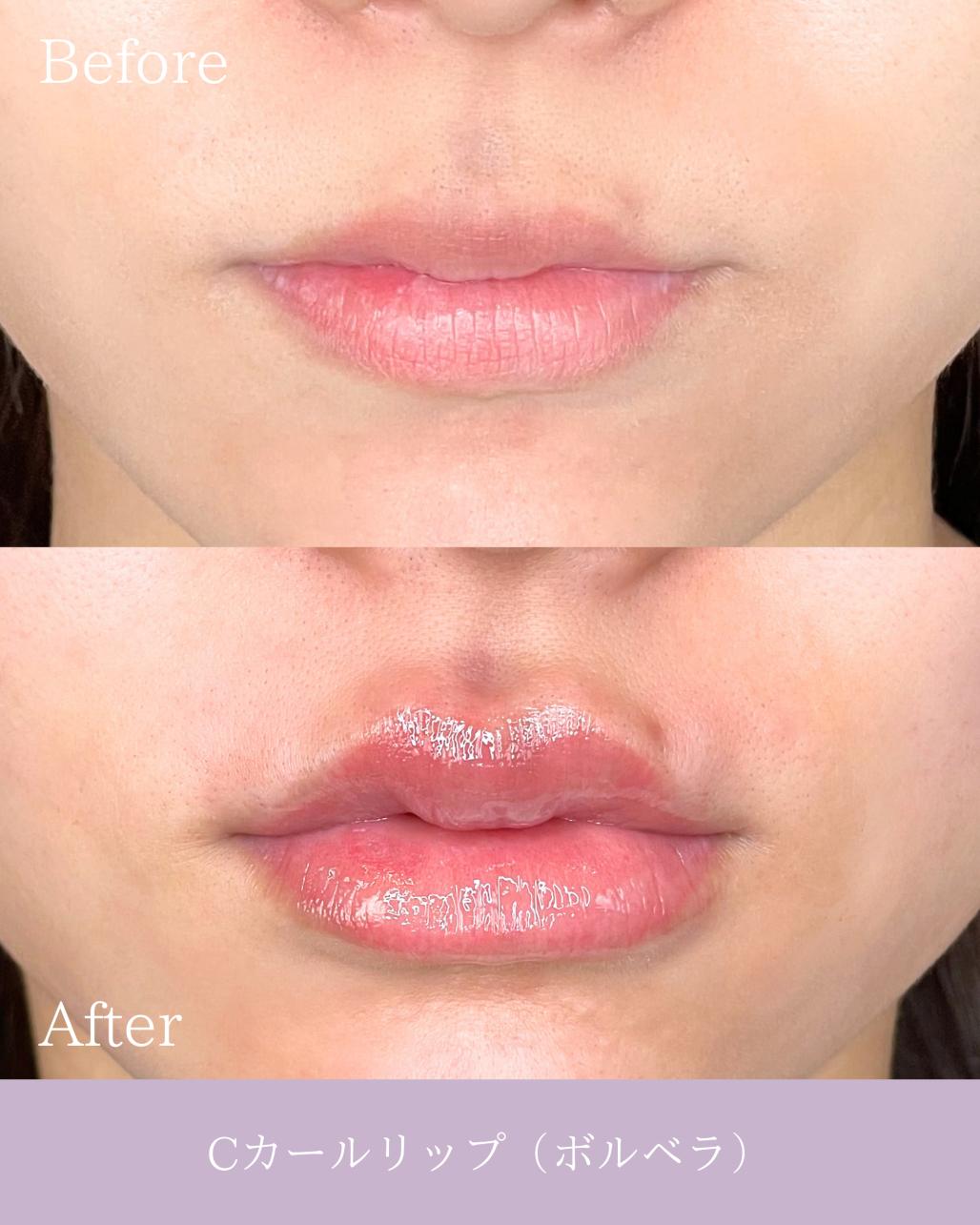 Cカールリップの症例写真