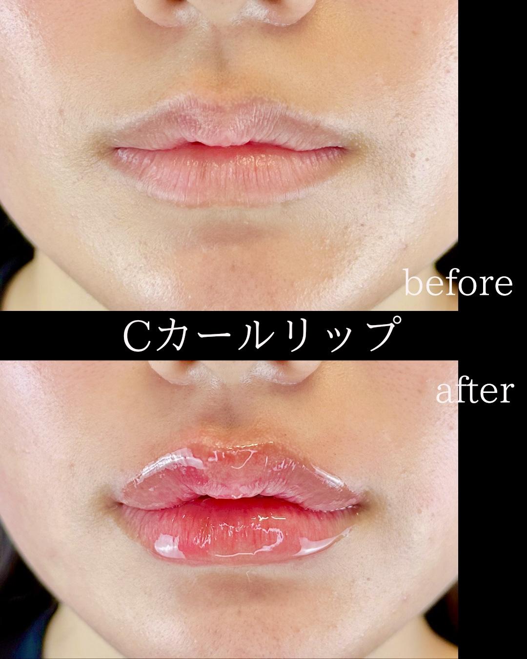 Cカールリップの症例写真