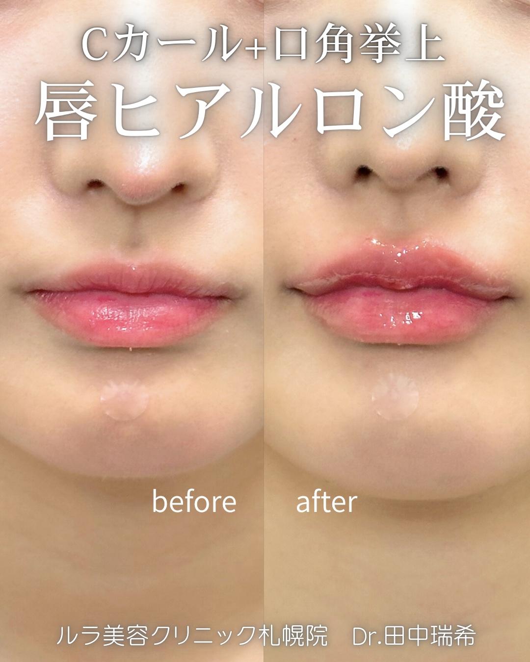 Cカールリップの症例写真