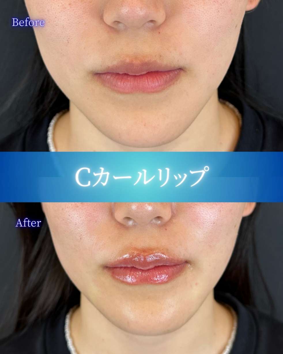 Cカールリップの症例写真