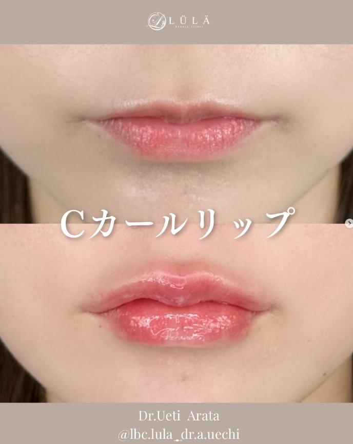 Cカールリップの症例写真