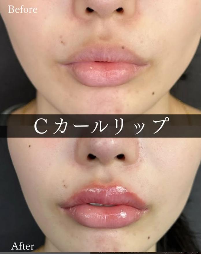 Cカールリップの症例写真