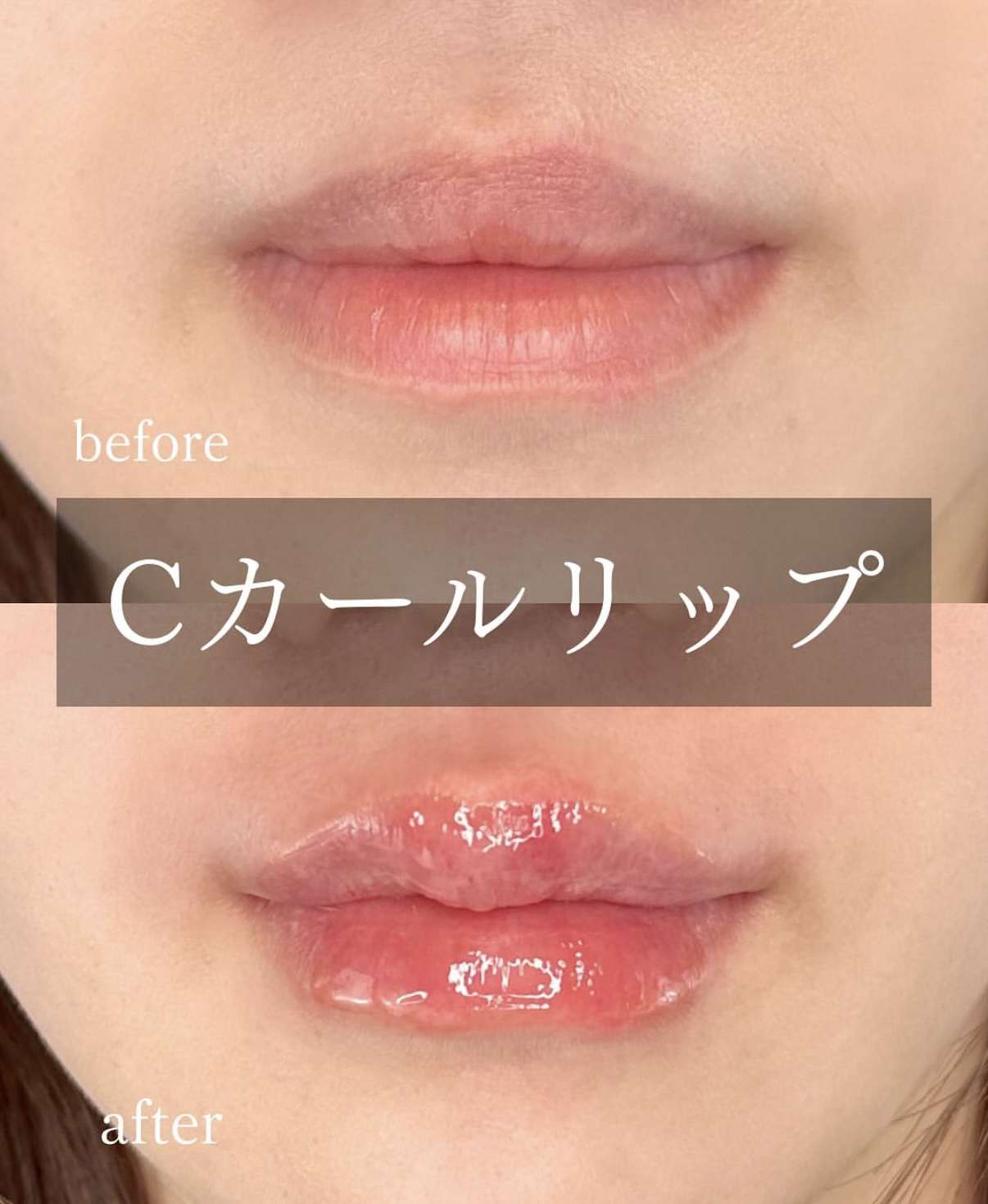 Cカールリップの症例写真