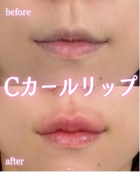 Cカールリップの症例写真