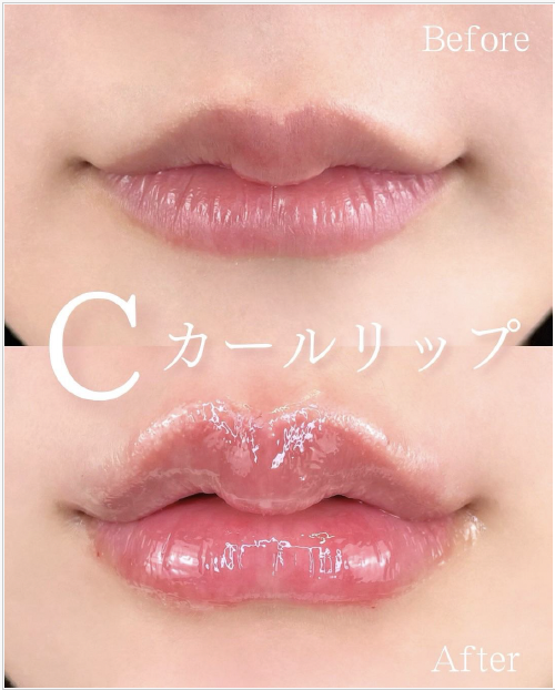 Cカールリップの症例写真