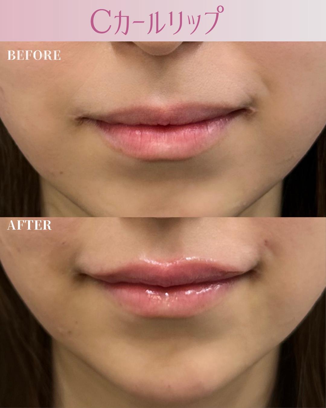 Cカールリップの症例写真