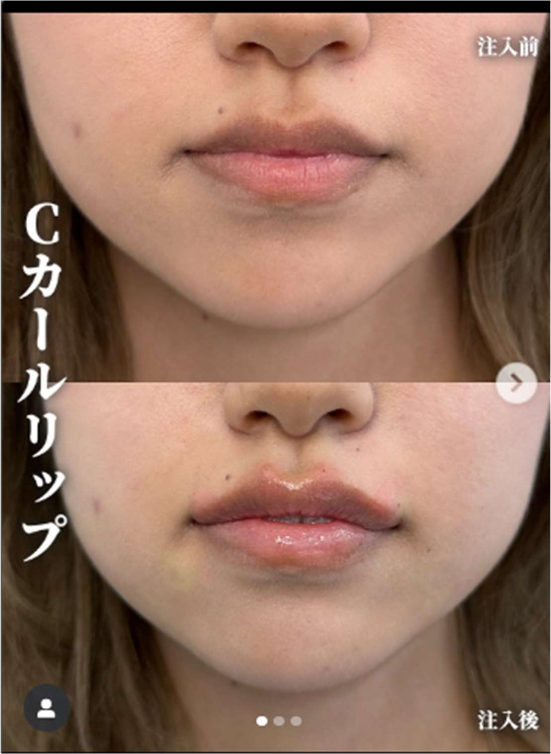 Cカールリップの症例写真