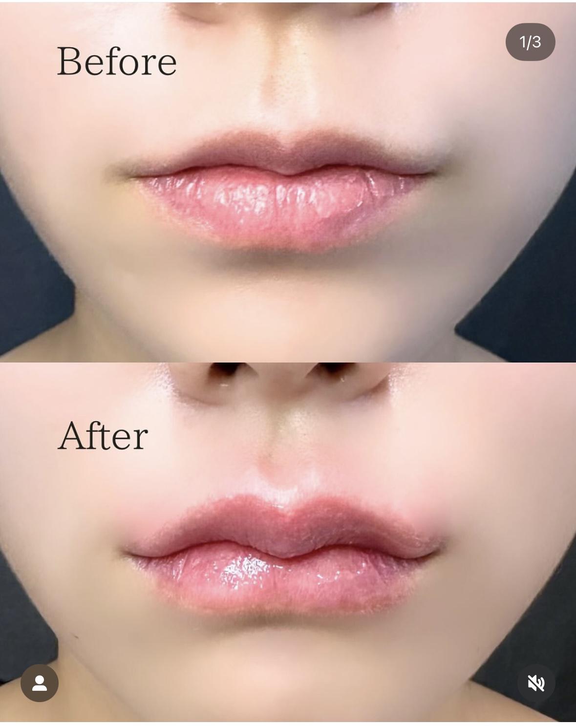 Cカールリップの症例写真