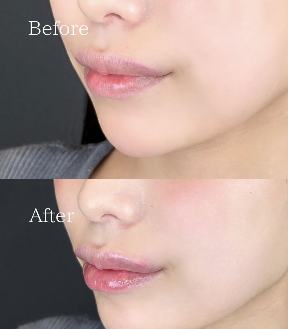 Cカールリップの症例写真