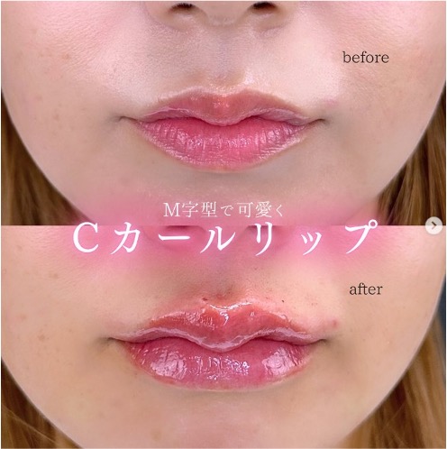 Cカールリップの症例写真