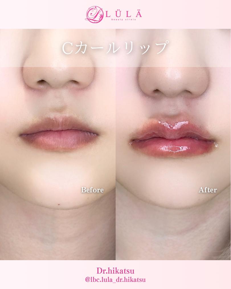 Cカールリップの症例写真