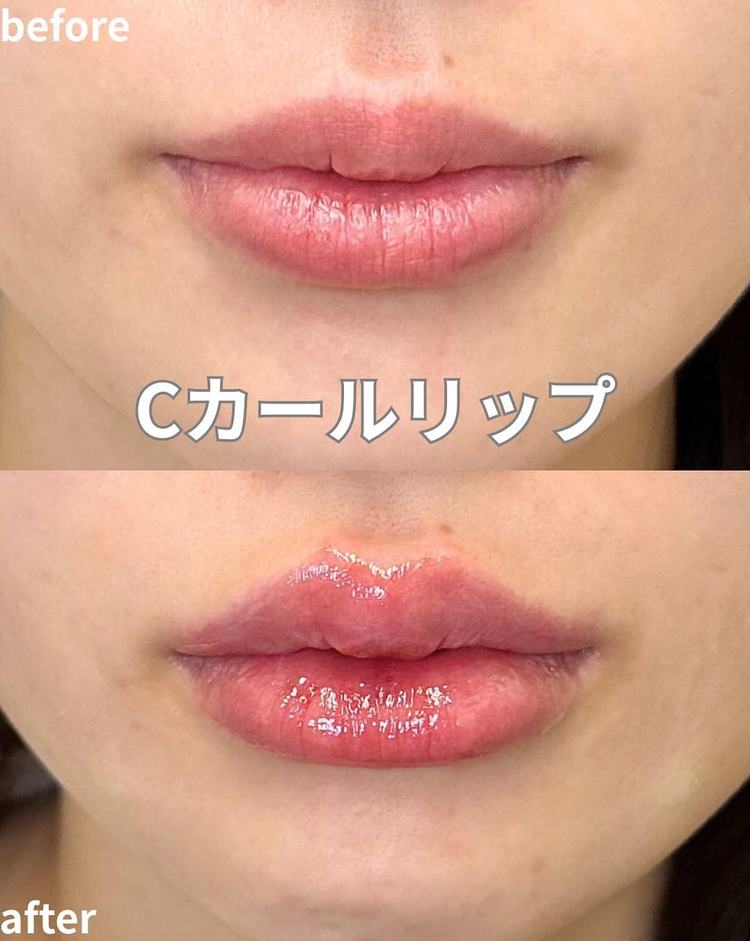 Cカールリップの症例写真