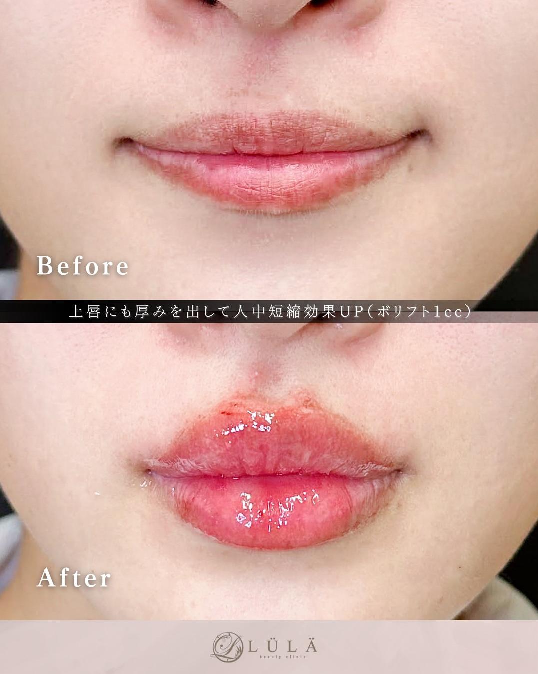 Cカールリップの症例写真