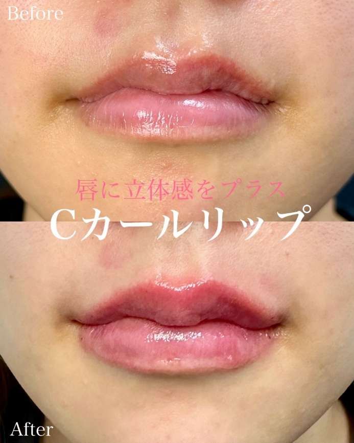 Cカールリップの症例写真