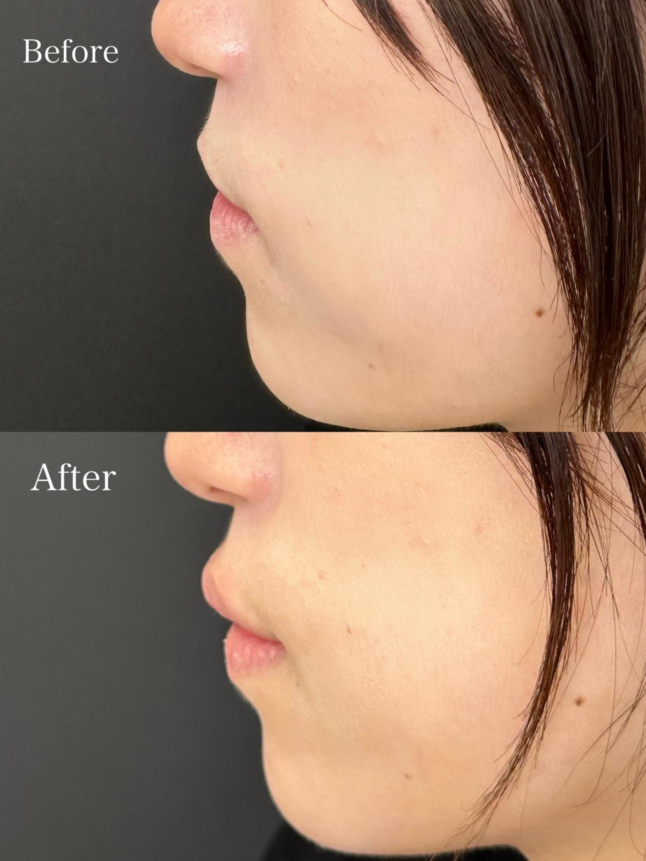 Cカールリップの症例写真