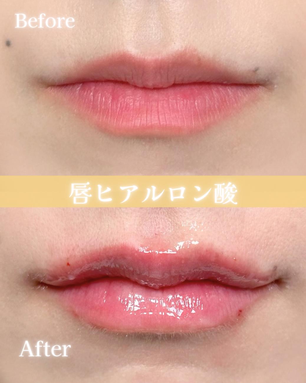 Cカールリップの症例写真