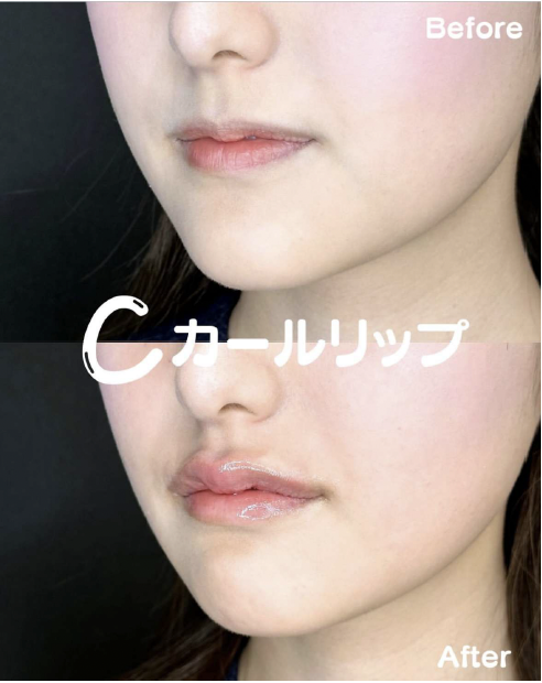 Cカールリップの症例写真