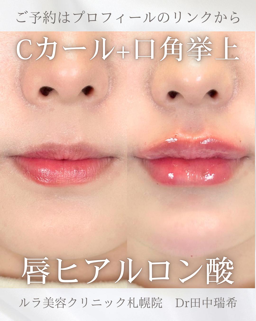 Cカールリップの症例写真