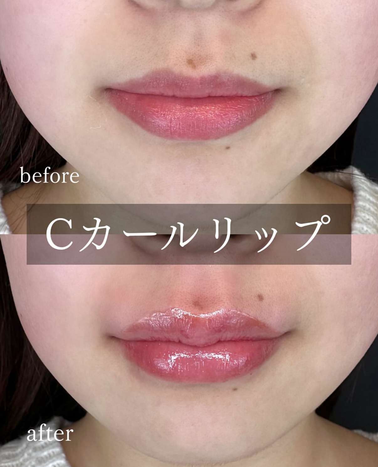 Cカールリップの症例写真