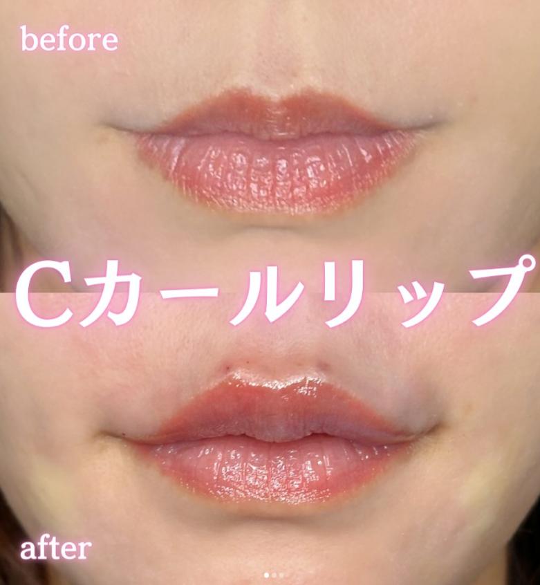 Cカールリップの症例写真