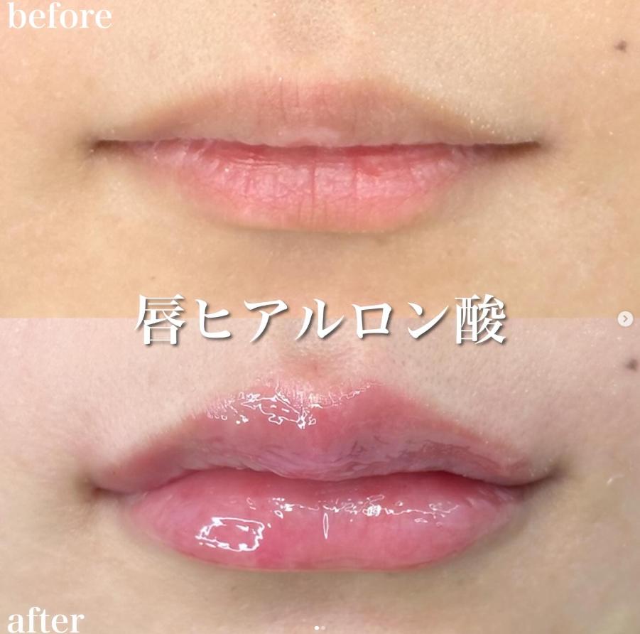 Cカールリップの症例写真