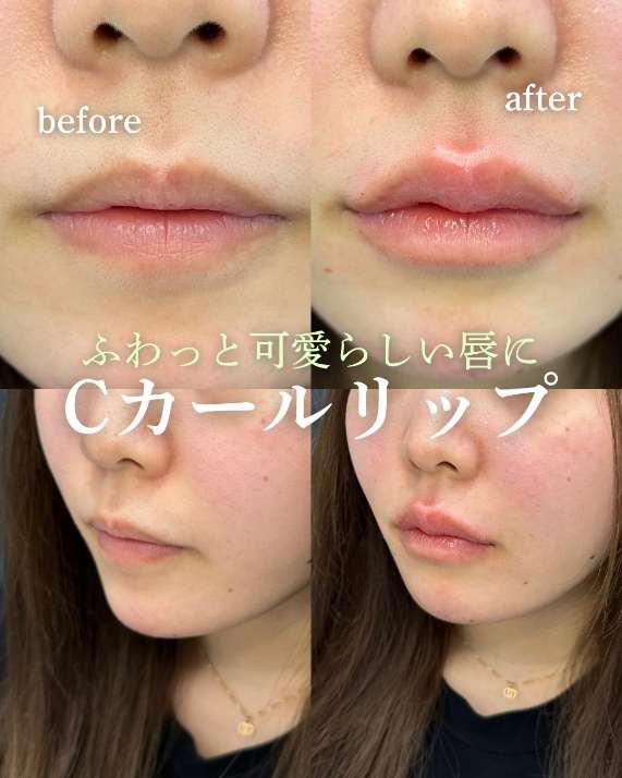 Cカールリップの症例写真