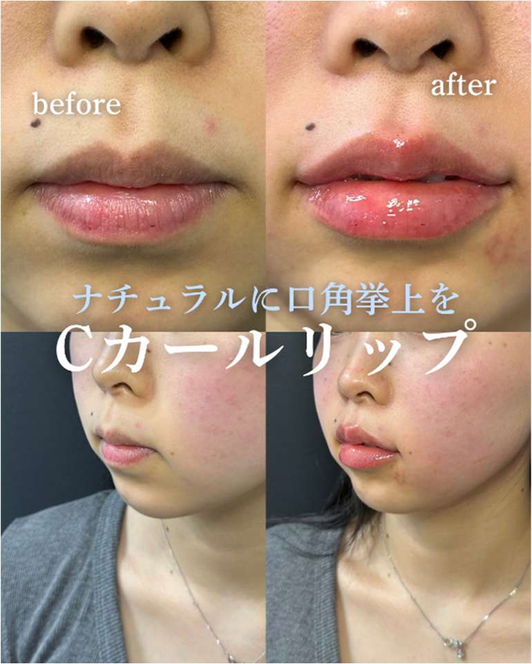 Cカールリップの症例写真