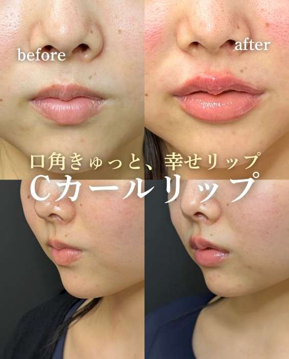 Cカールリップの症例写真