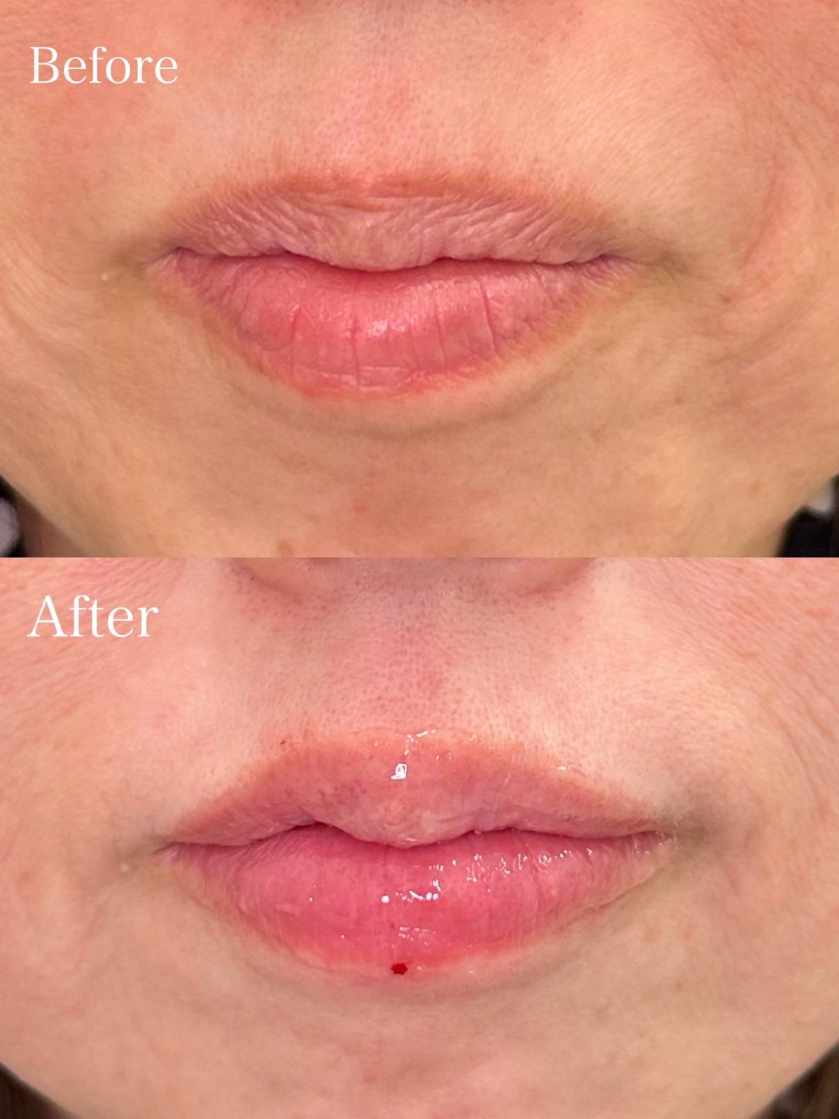 Cカールリップの症例写真