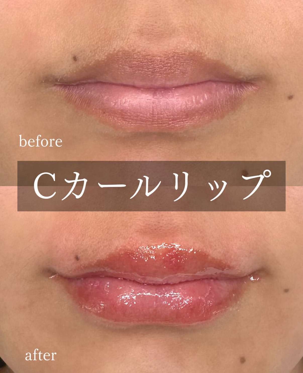 Cカールリップの症例写真