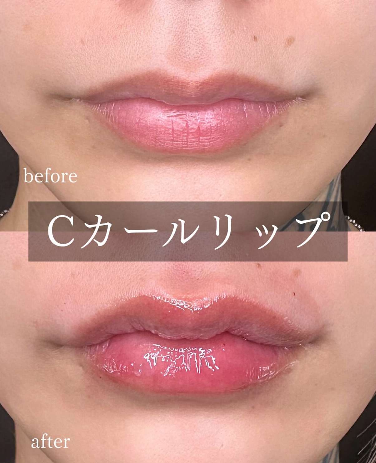 Cカールリップの症例写真